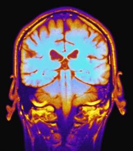 Anterograde Amnesia In Psychology: Definition & Examples 4 amnesia