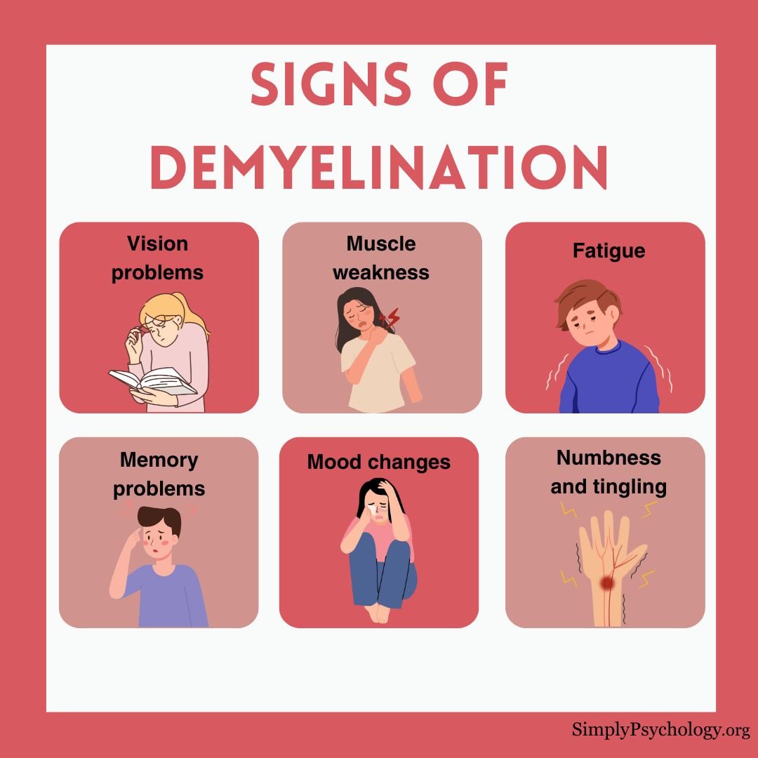 Demyelination Signs A 6-panel infographic titled "signs of demyelination" with some common signs such as vision problems, muscle weakness, and fatigue - associated images for each sign.