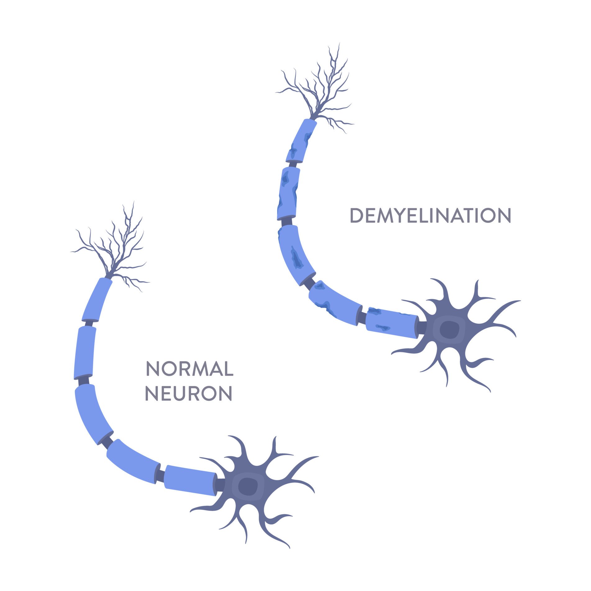 Demyelination: Symptoms, Causes, Diagnosis, Treatment 3 demyelination