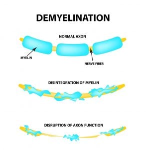 Demyelination: Symptoms, Causes, Diagnosis, Treatment 29 demyelination2