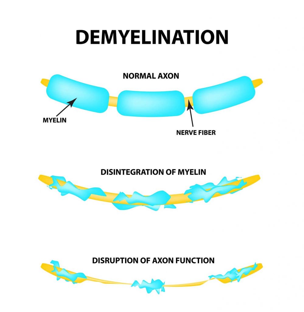 Demyelination: Symptoms, Causes, Diagnosis, Treatment 1 demyelination2