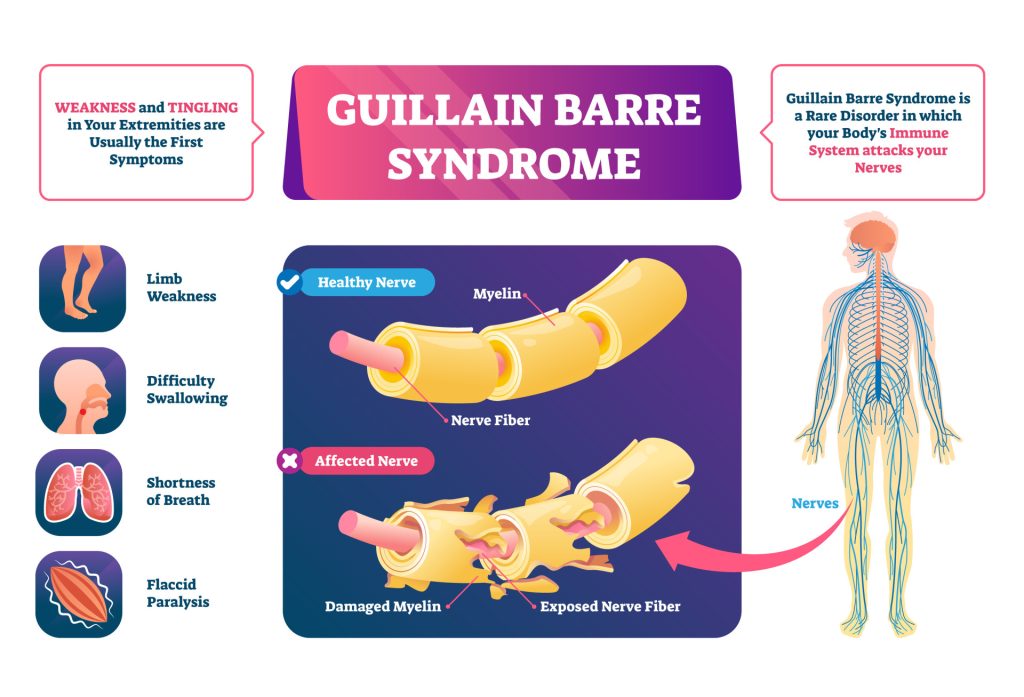 Spinal Nerves: Anatomy, Function, Diagram, Number, & Facts 8 Guillain Barre syndrome
