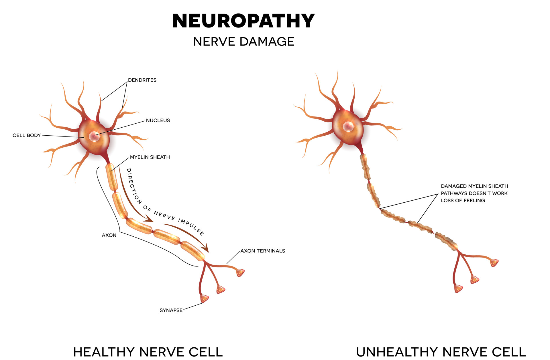 Neuropathy Neuropathy, nerve damage