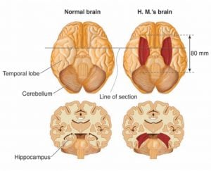 Henry Gustav Molaison: The Curious Case of Patient H.M. 11 patient hm brain